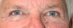 Eyelid Surgery (Blepharoplasty)