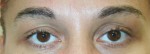 Eyelid Surgery (Blepharoplasty)