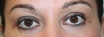 Eyelid Surgery (Blepharoplasty)