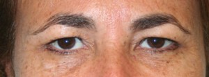 Eyelid Surgery (Blepharoplasty)
