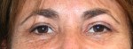 Eyelid Surgery (Blepharoplasty)