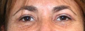 Eyelid Surgery (Blepharoplasty)