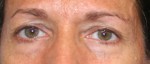 Eyelid Surgery (Blepharoplasty)