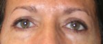 Eyelid Surgery (Blepharoplasty)