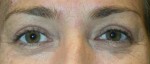 Eyelid Surgery (Blepharoplasty)