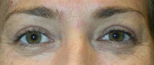 Eyelid Surgery (Blepharoplasty)