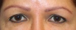 Eyelid Surgery (Blepharoplasty)