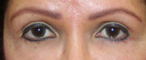 Eyelid Surgery (Blepharoplasty)
