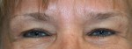 Eyelid Surgery (Blepharoplasty)