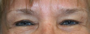 Eyelid Surgery (Blepharoplasty)