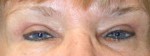 Eyelid Surgery (Blepharoplasty)