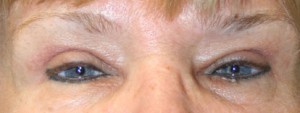 Eyelid Surgery (Blepharoplasty)