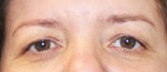 Eyelid Surgery (Blepharoplasty)