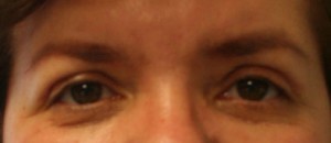 Eyelid Surgery (Blepharoplasty)