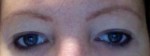 Eyelid Surgery (Blepharoplasty)