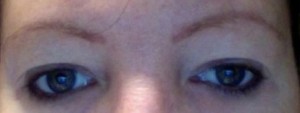 Eyelid Surgery (Blepharoplasty)