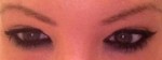 Eyelid Surgery (Blepharoplasty)