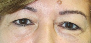 Eyelid Surgery (Blepharoplasty)