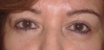 Eyelid Surgery (Blepharoplasty)