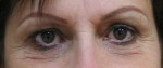 Eyelid Surgery (Blepharoplasty)