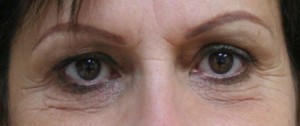 Eyelid Surgery (Blepharoplasty)