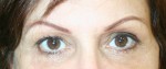 Eyelid Surgery (Blepharoplasty)