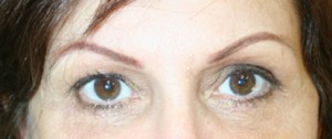 Eyelid Surgery (Blepharoplasty)
