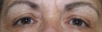 Eyelid Surgery (Blepharoplasty)