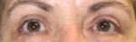 Eyelid Surgery (Blepharoplasty)