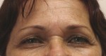 Eyelid Surgery (Blepharoplasty)
