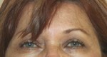 Eyelid Surgery (Blepharoplasty)