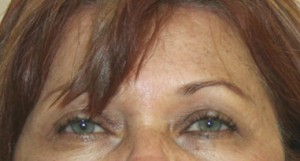 Eyelid Surgery (Blepharoplasty)