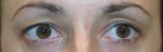 Eyelid Surgery (Blepharoplasty)
