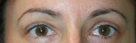 Eyelid Surgery (Blepharoplasty)