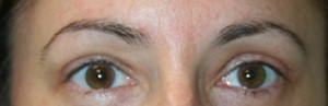 Eyelid Surgery (Blepharoplasty)