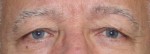 Eyelid Surgery (Blepharoplasty)