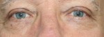 Eyelid Surgery (Blepharoplasty)