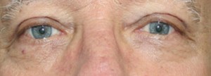 Eyelid Surgery (Blepharoplasty)