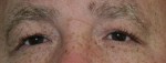 Eyelid Surgery (Blepharoplasty)