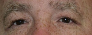 Eyelid Surgery (Blepharoplasty)