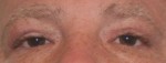 Eyelid Surgery (Blepharoplasty)