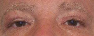 Eyelid Surgery (Blepharoplasty)