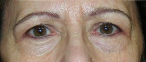 Eyelid Surgery (Blepharoplasty)