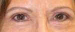 Eyelid Surgery (Blepharoplasty)