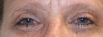 Eyelid Surgery (Blepharoplasty)