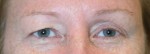 Eyelid Surgery (Blepharoplasty)
