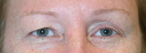 Eyelid Surgery (Blepharoplasty)