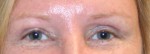 Eyelid Surgery (Blepharoplasty)