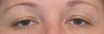 Eyelid Surgery (Blepharoplasty)