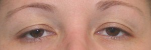 Eyelid Surgery (Blepharoplasty)